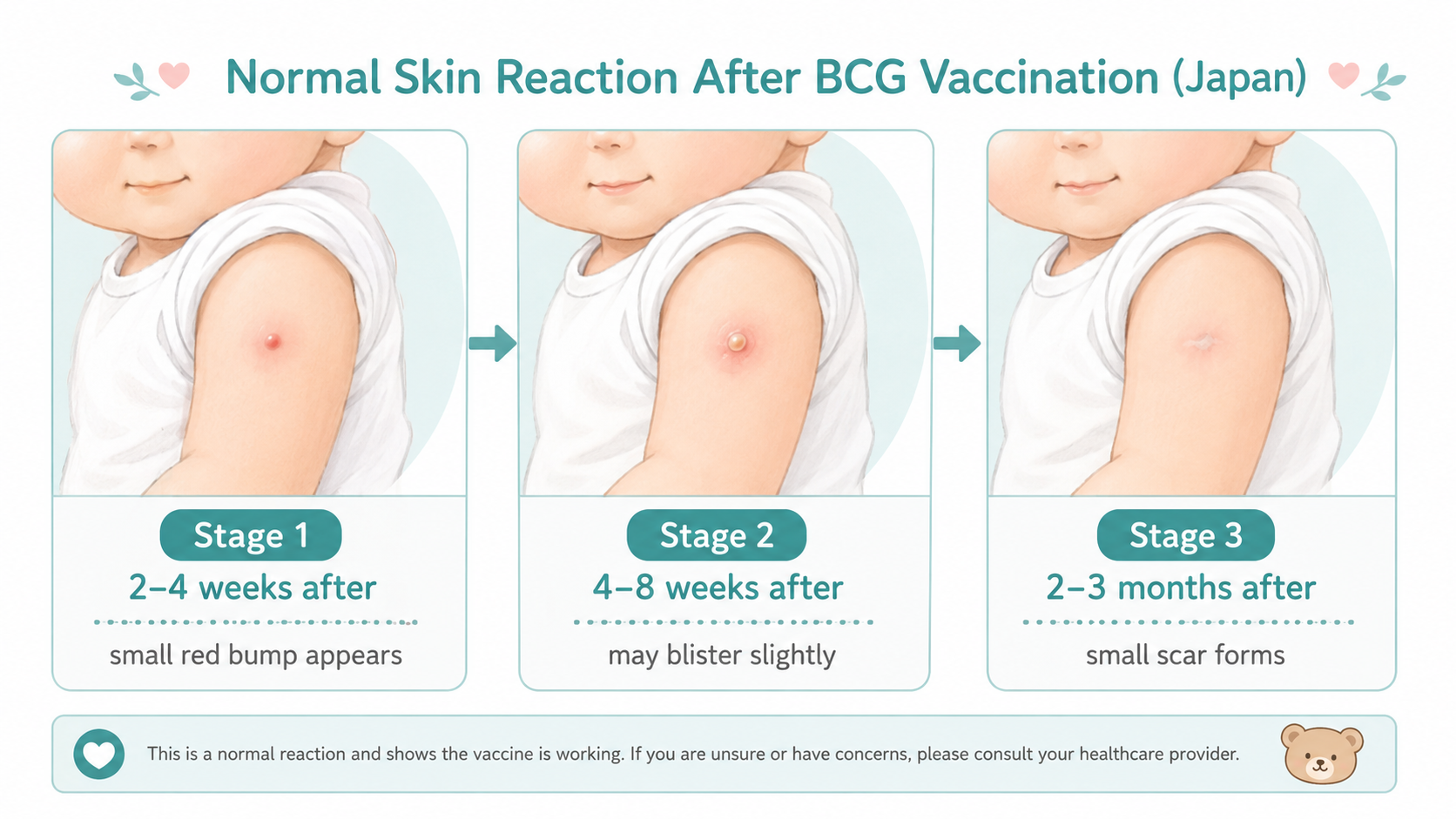 Three-stage illustration of normal BCG skin reaction: red bump, blister, and small scar