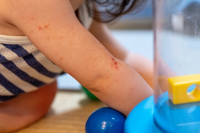 Close-up of HFMD rash blisters on a child's arm