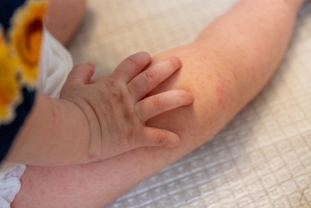 Close-up of HFMD rash blisters on a baby's hand