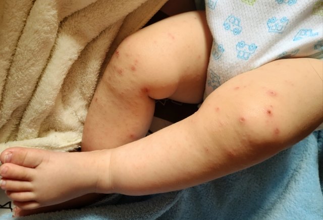 HFMD rash blisters on a baby's legs and feet