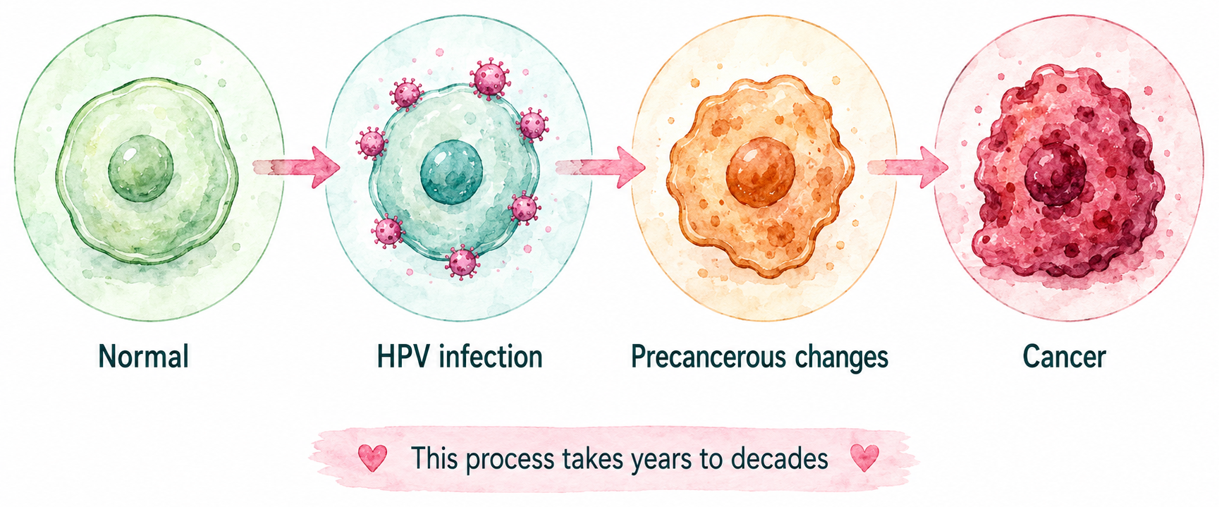 HPV progression diagram: four stages from normal cell to HPV infection to precancerous changes to cancer, with note that the process takes years to decades